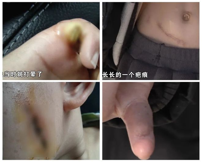 了！5岁儿童爬空调外机瞬间晕厥！人生就是博-尊龙凯时肌腱都打断(图5)
